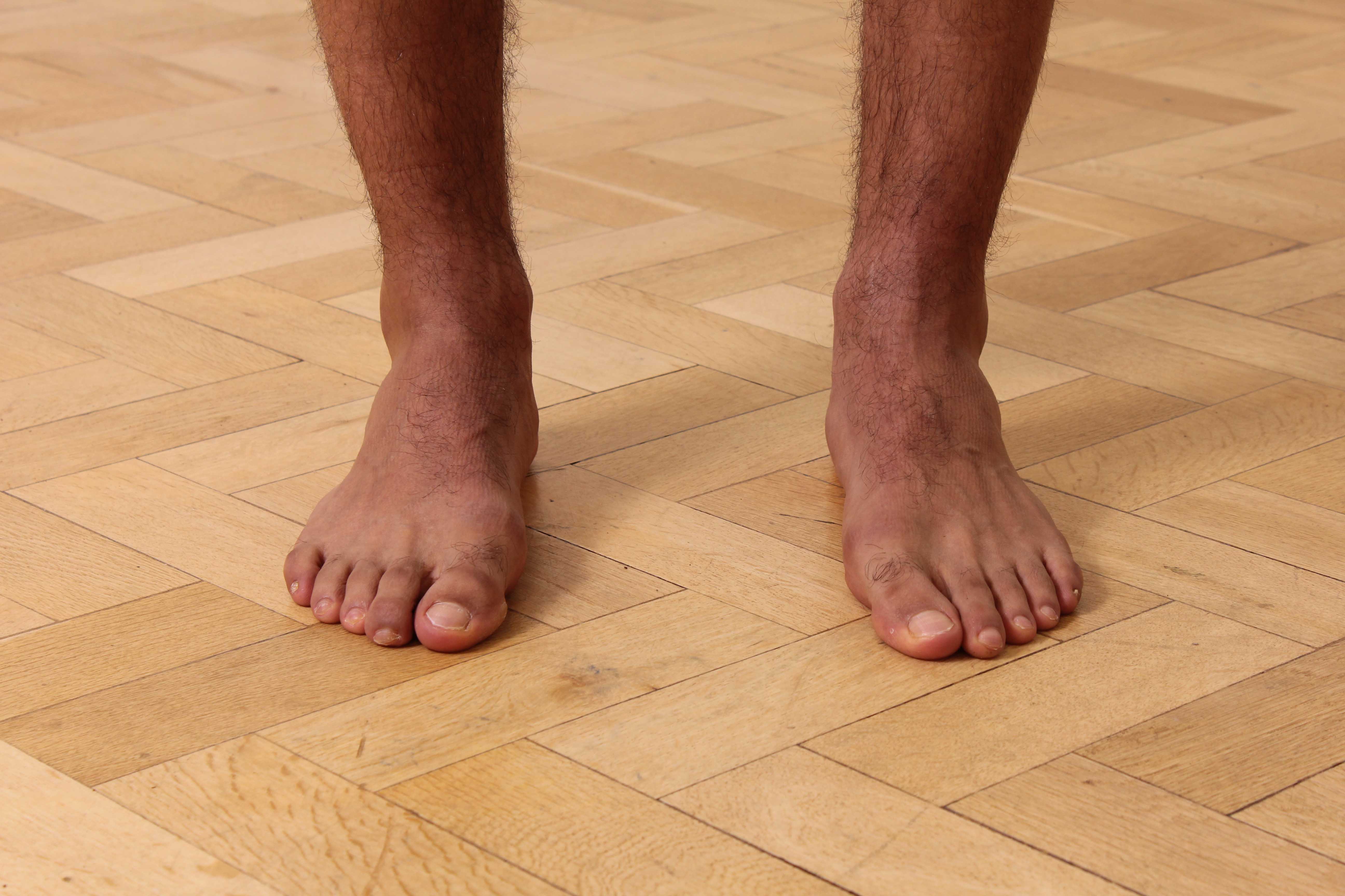A thorough assesment of your foot position will help physiotherapist find the cause of your problem.